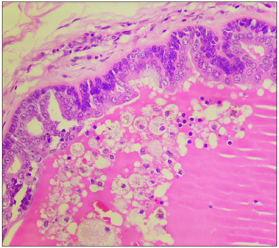 Histopathology showing tubular structures with decapitation secretion (Haematoxylin and Eosin; 400x).