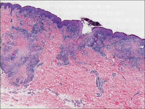 Three palisading granulomas in the dermis with one superficial granuloma perforating through the hair follicle (Haematoxylin and eosin, 20x).