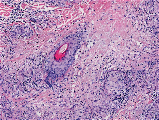 Epithelial histiocyte granulomas arranged in palisade formation, displaying a central core of degenerated collagen, mucin and follicular structures, surrounded by histiocytes, multinucleated giant cells, lymphocytes, scattered eosinophils and neutrophils (Haematoxylin and eosin, 100x).