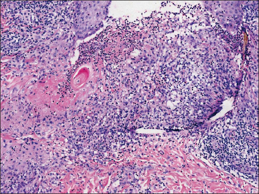 Degenerated collagen at the centre of palisading granuloma undergoing transepidermal elimination through the follicular infundibulum. The dense neutrophil aggregation and nuclear dust in and around the hair follicle are also observed (Haematoxylin and eosin,100x).