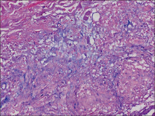 Abundant mucin in the centre of the palisading granuloma’s focus (Alcian blue, 200x).