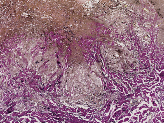 Degeneracy and loss of elastic fibres within the granuloma, part of which are expelled along with necrotic tissue (Elastic-van Gieson, 100x).