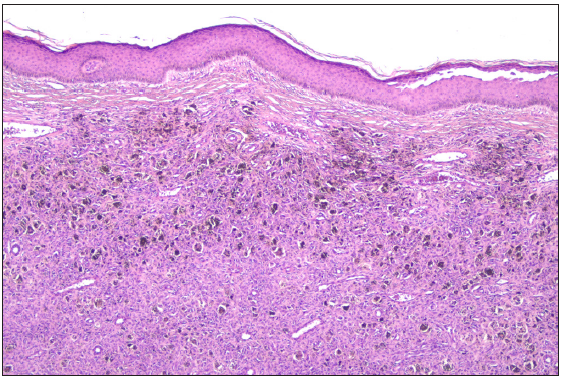 Intradermal cellular proliferation of fusiform fibrohistiocytic cells. (Haematoxylin & eosin, 40x).