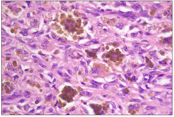 Intracellular and interstitial hemosiderin deposits. (Haematoxylin & eosin, 400x).