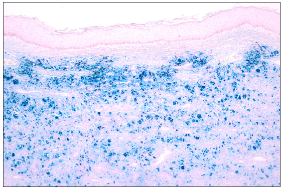 Positive Perls’ staining. (40x).