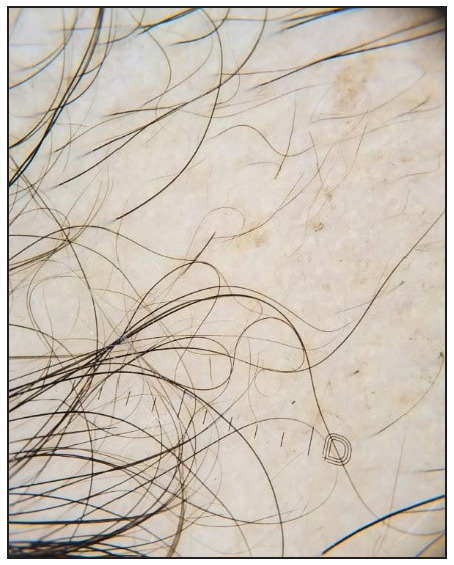 Alopecia areata showing regrowing hairs (Dermlite ™ DL5 polarised mode).