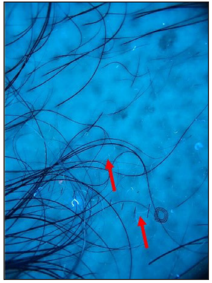 White hairs are seen more clearly under UV dermoscopy (red arrows) (Dermlite ™ DL5 UV mode).