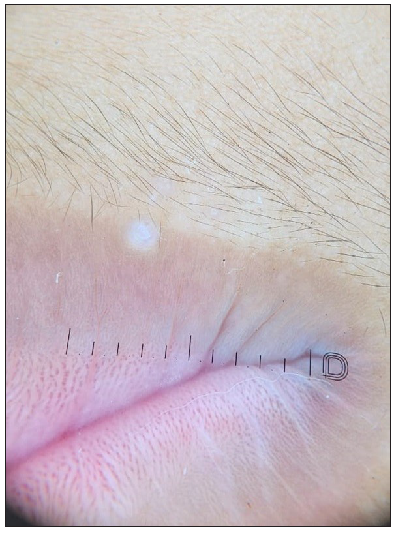 Dermoscopy of molluscum contagiosum (Dermlite ™ DL5 polarised mode).