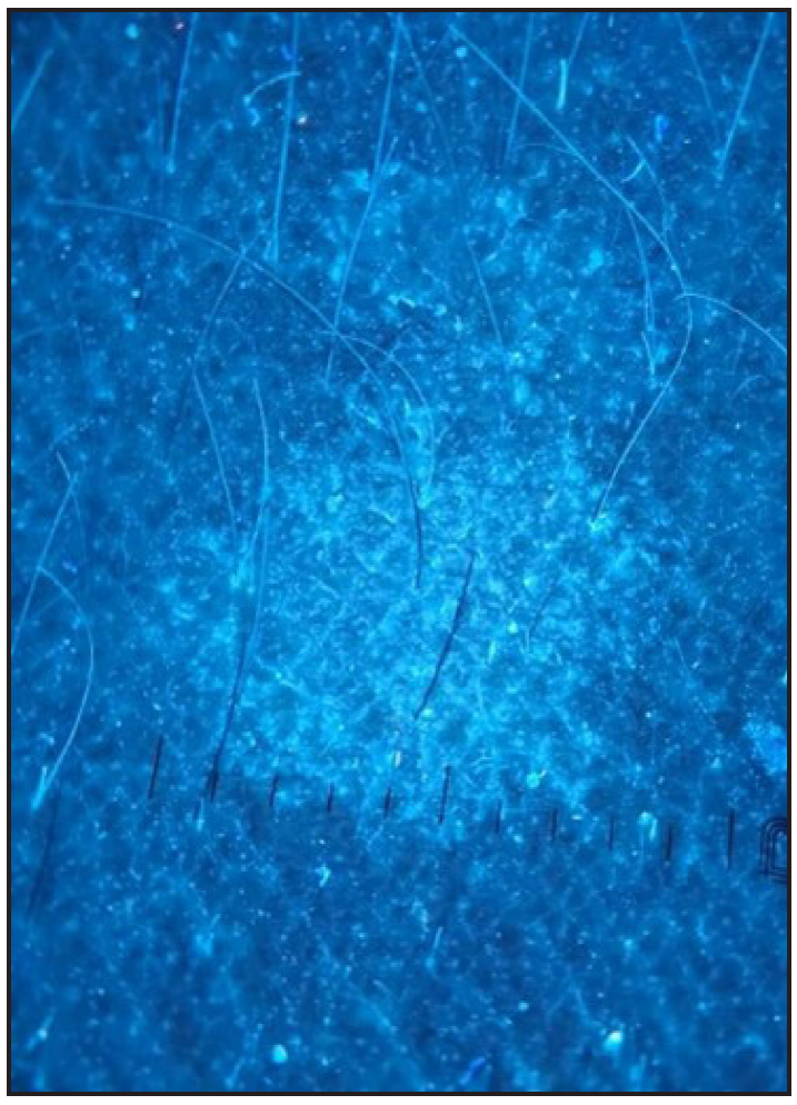 Dermoscopy of hypopigmented pityriasis versicolor – fines scales are visible more clearly (Dermlite ™ DL5 UV mode).