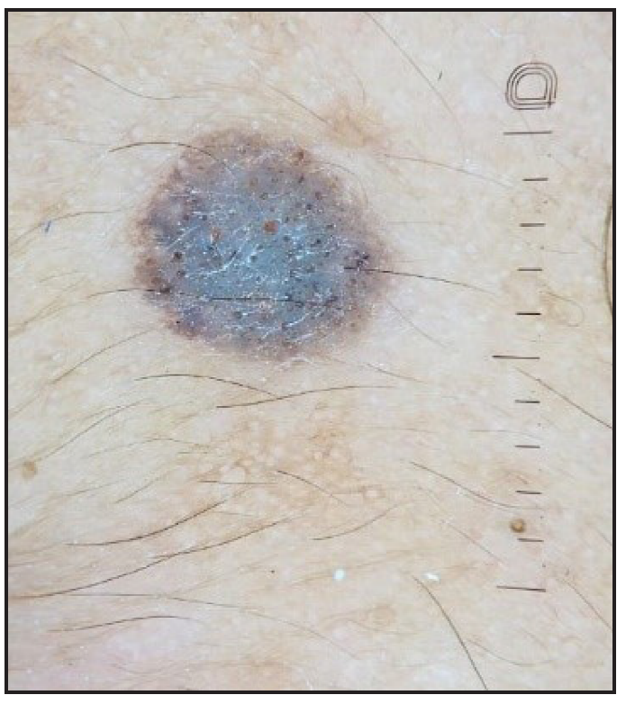 The UV dermoscopic blink sign in seborrheic keratosis (Dermlite ™ DL5 polarised mode).