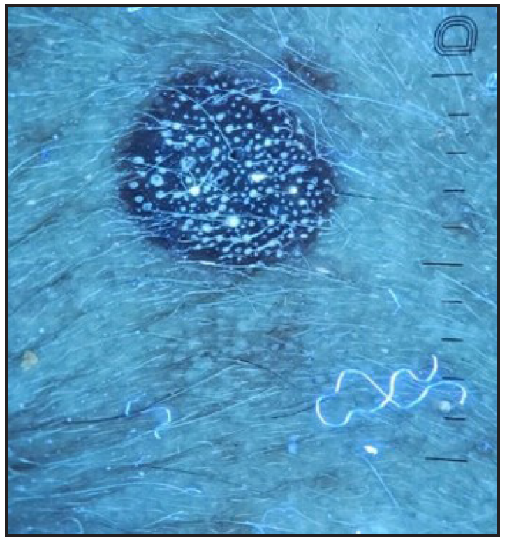 The UV dermoscopic blink sign in seborrheic keratosis (Dermlite ™ DL5 UV mode).