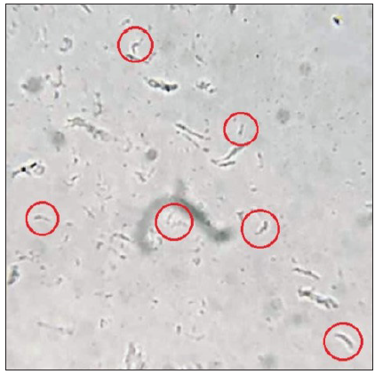 Wet mount microscopy (400x) shows spiral structures (highlighted in red circles) indicative of spirochetes.