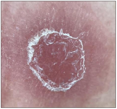 Collarette of scales visible to the naked eye was confirmed on dermoscopy which showed scales arranged in linear configuration which was suggestive of Biett’s collarette. (Polarised, contact, x10).