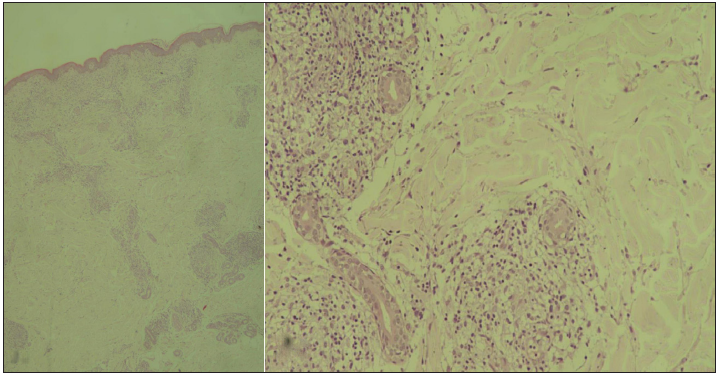 Skin biopsy from a nodule scanner view shows inflammatory infiltrates in superficial as well as deep dermis. The infiltrates are arranged mainly around the vessels and appendages (Haematoxylin & Eosin, x40). Higher magnification reveals the infiltrate to be well formed granulomas concentrated around the vessels and appendages (Hematoxylin and Eosin; 200x)