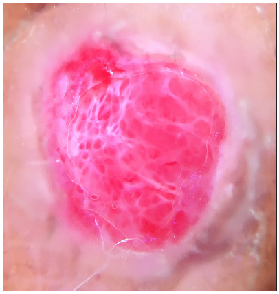 Dermoscopy of pyogenic granuloma showing multiple red lacune, homogenous red zone with interconnected perpendicular white lines (also called rail lines), subtle surrounding scale (called collarette), and vessels in the periphery with conspicuous absence of pigmentation structures (DermLite DL4; 3Gen; San Juan Capistrano, California, USA, noncontact polarised mode, 10x magnification).