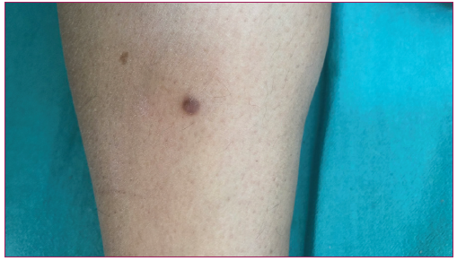 Clinical image of a patient with dermatofibroma.