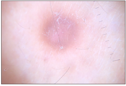 Dermatofibroma showing central white structureless zone with peripheral homogeneous pigmentation on dermoscopy (DermLite DL4; 3Gen; San Juan Capistrano, California, USA, noncontact polarised mode, 10x magnification).