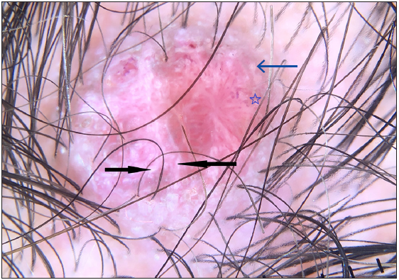 Dermoscopy of lesion showing similar findings of polymorphic vessels, white structures [white structureless zones, white lines (black arrow), dots] (blue arrow), brown structureless zone (blue star), peripheral rim of pigmentation (DermLite DL4; 3Gen; San Juan Capistrano, California, USA, noncontact polarised mode, 10x magnification).