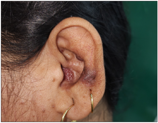 Clinical image of another patient with corresponding erythematous plaque, nodule and postinflammatory hyperpigmentation over concha and antihelix of left ear of the patient 2.