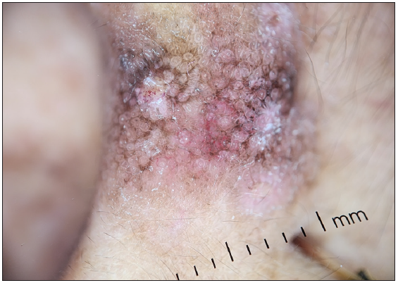 Dermoscopic examination showing a prominent pigment network, brown dots, along with vessels, and white structures (DermLite DL4; 3Gen; San Juan Capistrano, California, USA, noncontact polarised mode, 10x magnification).