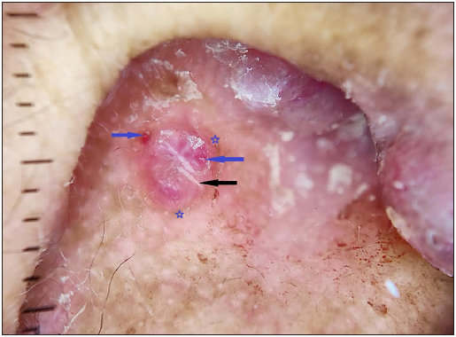 Dermoscopy examination showing clods (red-purple lacunes, blue arrow), polarising white lines (black arrow), and vessels with a peripheral rim of pigmentation (blue star) seen (DermLite DL4; 3Gen; San Juan Capistrano, California, USA, noncontact polarised mode, 10x magnification).