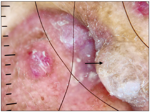 Late lesion (black arrow) of the same patient 3 showing white structures, pigmentation structures with absence of clods (DermLite DL4; 3Gen; San Juan Capistrano, California, USA, noncontact polarised mode, 10x magnification).