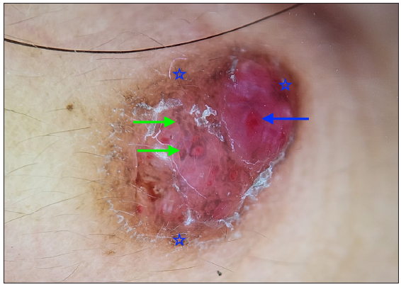 Dermoscopy showing clods (red-purple lacunes, blue arrow), white scale, and pigmentation structures (green arrow) seen in dermoscopy of another patient. Note the peripheral rim of pigmentation (blue star). (DermLite DL4; 3Gen; San Juan Capistrano, California, USA, noncontact polarised mode, 10x magnification).