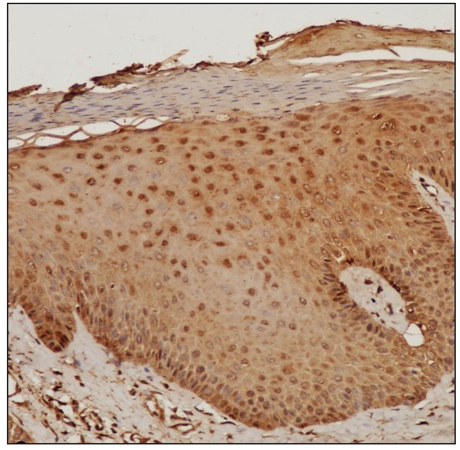 IHC of the involved skin showing moderate nuclear positivity in the keratinocytes (STAT3, 100x).