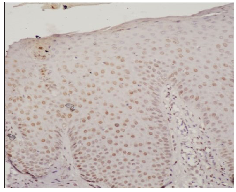 IHC of the uninvolved skin showing weak nuclear positivity in the keratinocytes (STAT3, 400x).