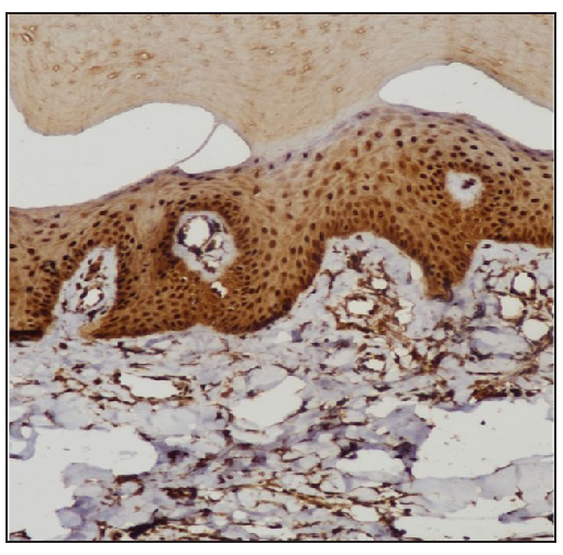 IHC of involved skin showing strong nuclear positivity in the keratinocytes (STAT6, 400x).