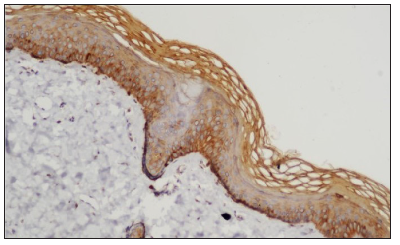 IHC of the uninvolved skin showing absence of STAT6 staining in the nuclei of keratinocytes (STAT6, 400x).