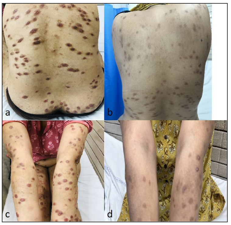 (a) Multiple hyperpigmented to flesh-coloured nodules and plaques present over the back. (b) Resolution of lesions on the back with post-inflammatory hyperpigmentation post tofacitinib therapy. Tofacitinib (extended release tablet) 11 mg for mean duration of 3 months. (c) Multiple flesh-coloured nodules present over both upper limbs. (d) Resolution of lesions on upper limbs with post-inflammatory hyperpigmentation post-tofacitinib therapy. Tofacitinib (extended release tablet) 11 mg for mean duration of 3 months