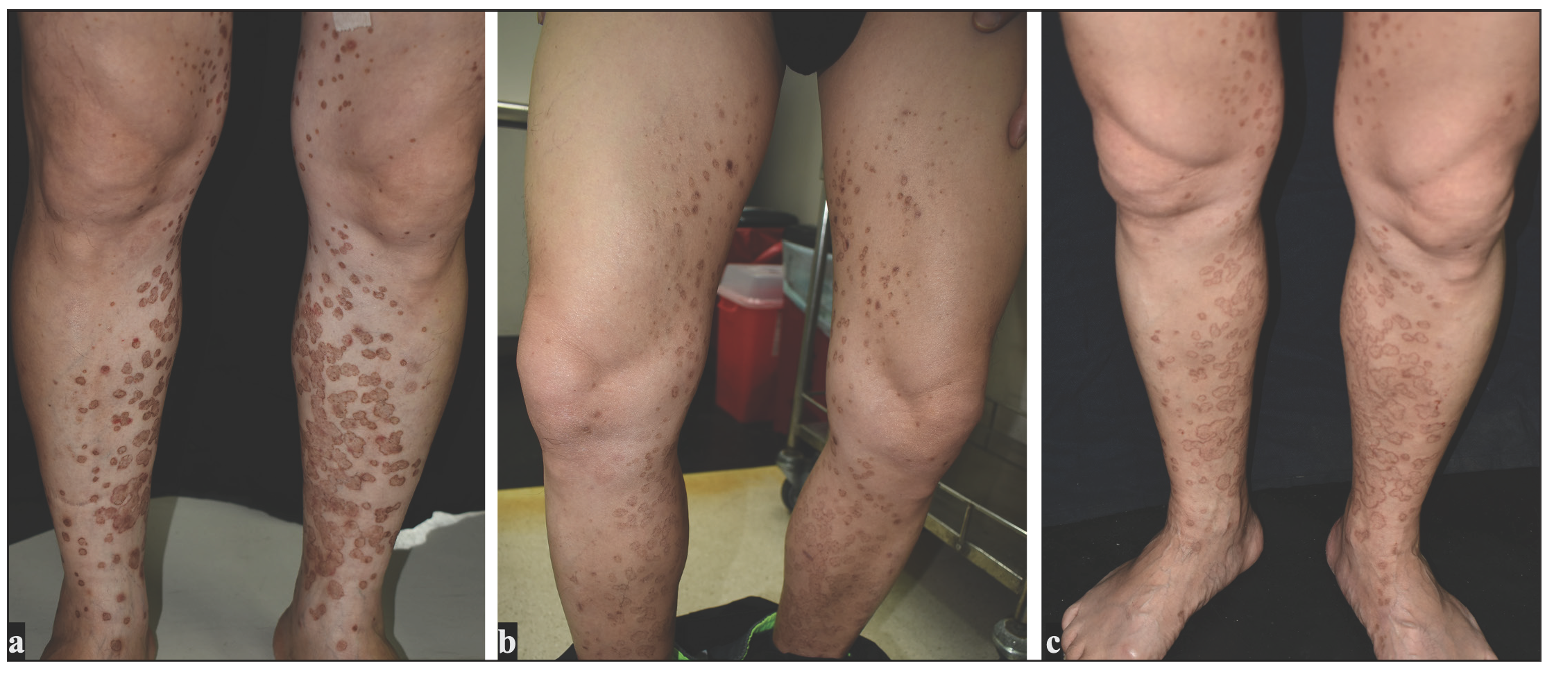 (a) Porokeratosis lesions on the lower legs (b) flattening of lesions observed six months after introducing topical egg yolk oil (c) aggravation of lesions after topical egg yolk oil discontinuation.