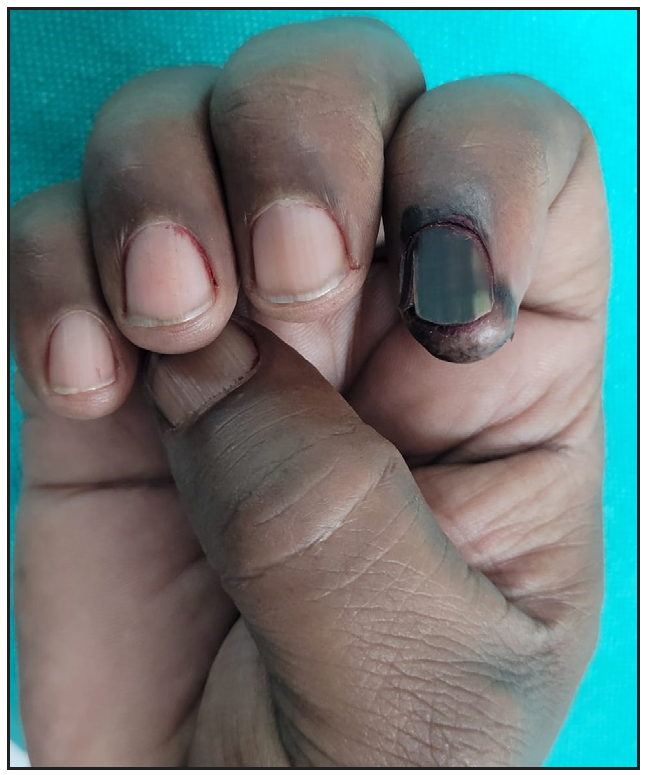 Hyperpigmented, dystrophic and friable nail plate with hyperpigmentation of proximal nail fold, hyponychium and periungual areas.