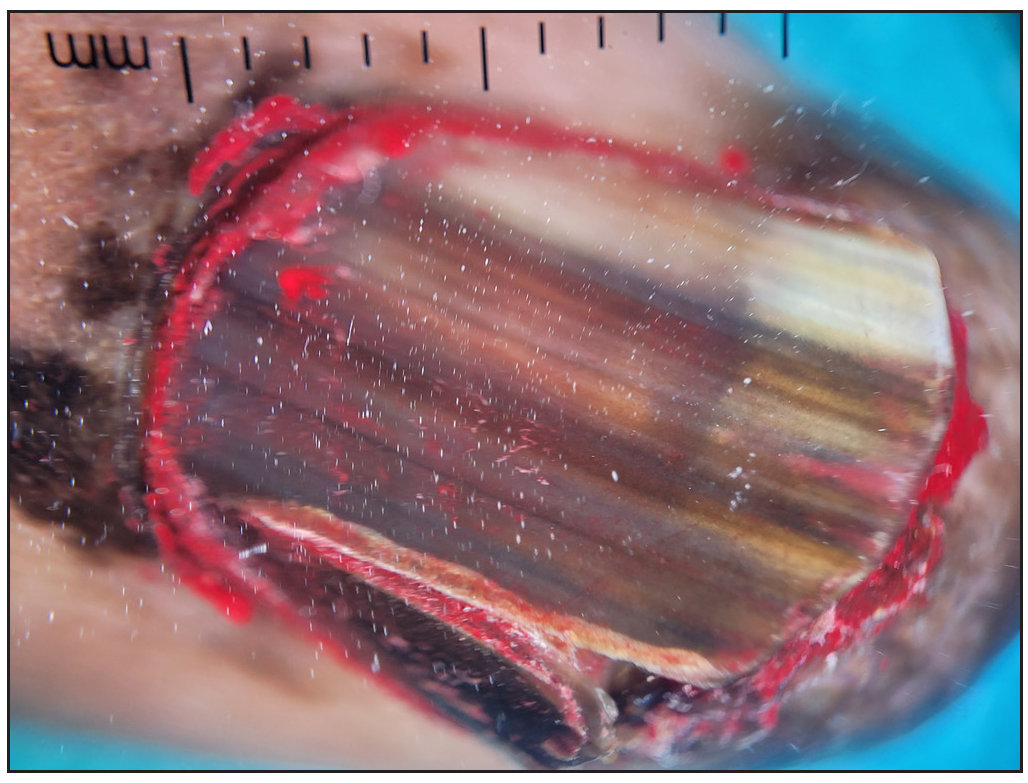 Longitudinal pigmented band involving>2/3rd of the nail, variegated in colour with longitudinal splitting of the nail plate. Reticular pigment network involving proximal nail fold.