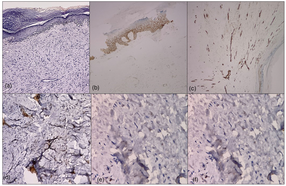 Nail matrix biopsy showing, (a) spindle cell tumour arranged in intersecting fascicles with interspersed thin-walled capillaries (Haematoxylin and eosin, 200x), (b) negative Immunohistochemistry (IHC) for Pan CK (cytokeratin) 200x, (c) negative CD34 (IHC 200x), (d) negative S-100 (IHC 200x), (e) positive beta-catenin IHC straining (200x) and (f) <1% Ki67 IHC stain positivity (200x)