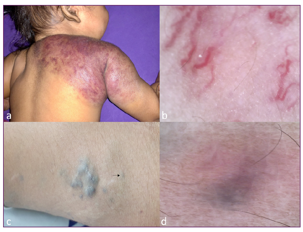 (a) A child with kaposiform hemangiothelioma showing Kasabach-Merritt phenomenon, over the shoulder, presenting as a dusky red ill-defined swelling, and (b) its dermoscopy, showing irregular vessels, similar to the ones seen in infantile hemangiomas or tufted angiomas. (Dino-Lite AF4115ZT 5MP, magnification 160x, polarized). (c) A venous malformation, presenting as discrete and linear bluish-green compressible swellings, and dermoscopy of one of the lesions (arrow) (d) showing a bluish structureless area (Dino-Lite AF4115ZT 5MP, magnification 160x, polarised).