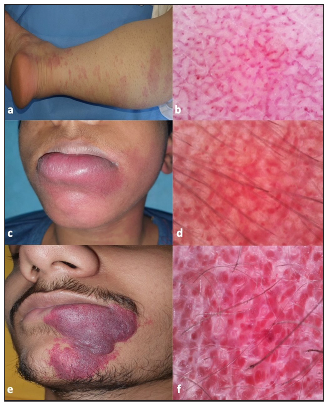 Clinical and dermoscopic images of capillary malformation/port-wine stain showing (a) faint pink color clinically corresponding to (b) dots and globules and broken network of thin vessels in dermoscopy, and (c) dark red colour showing (d) broken network of thick vessels, and (e) dark purple hypertrophic port-wine stain showing (f) sausage-shaped very thick vessels in a mostly intact network on dermoscopy (Dino-Lite AF4115ZT 5MP, magnification 160x, polarised).