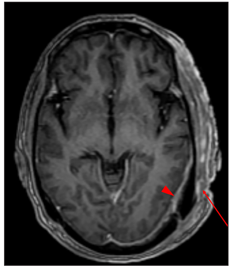 Axial T1W CEMRI showing a heterogeneously enhancing soft tissue thickening involving the scalp over the left temporo-occipital region (red arrow), with focal areas of erosion of the underlying calvaria enhancing dural thickening suggestive of pachymeningitis (red arrowhead).