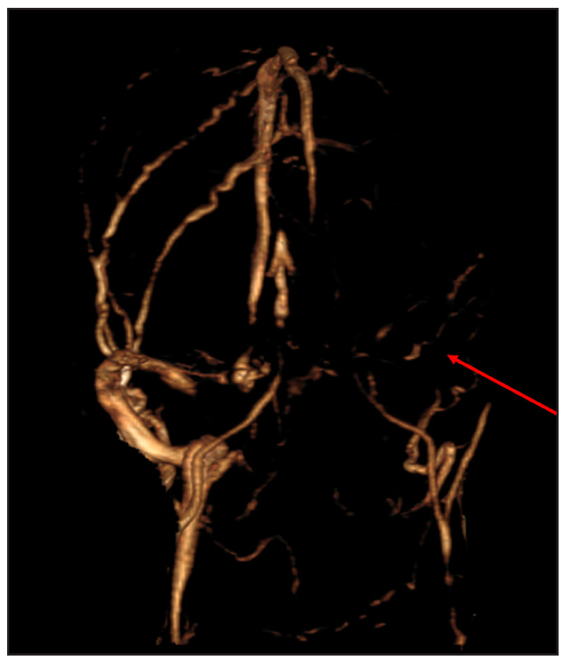 3D reconstructed Magnetic Resonance (MR) venogram showing involvement of the left transverse and sigmoid sinuses which are reconstituted by collaterals (red arrow).