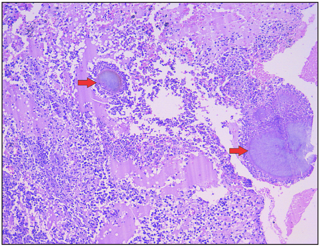 Abscess cavity containing two grains (red arrows) surrounded by neutrophils (Haematoxylin and eosin, 100x).