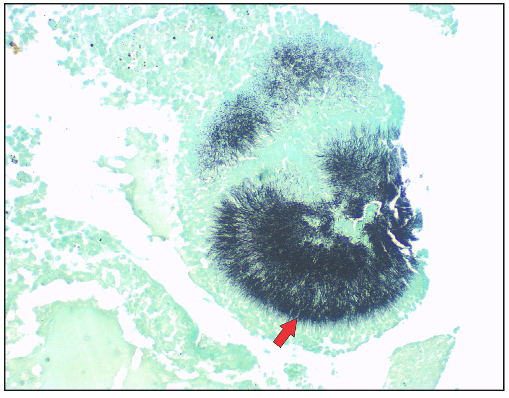 Thin filamentous Grocott Methenamine Silver (GMS) positive hyphae comprising the grain (red arrow) (GMS, 200x).