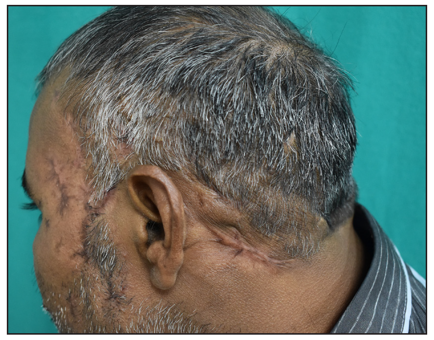 Healing of cutaneous lesions post six months of treatment.