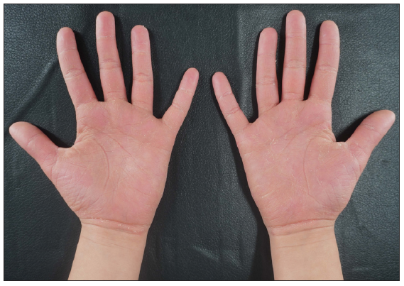 Well-defined hyperkeratosis and erythema on both palms accompanied by scaling of II-2 in pedigree 3.