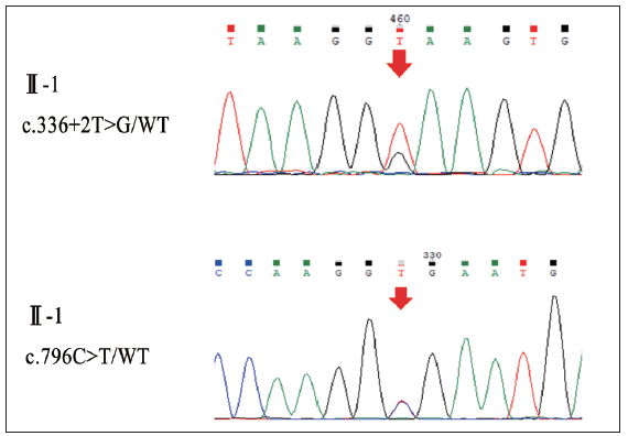 Sequencing results of the patient II-1 in pedigree 2. Red arrows: The mutation sites.