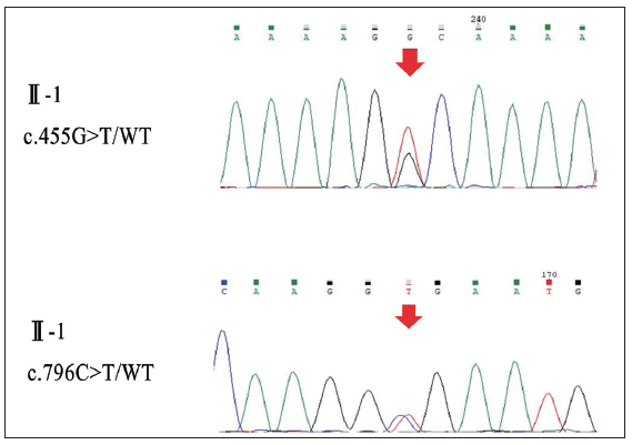 Sequencing results of the patient II-1 in pedigree 3. Red arrows: The mutation sites.