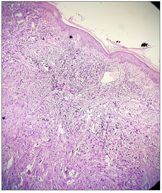 Infiltrative carcinoma in the full thickness of the dermis (Haematoxylin & eosin, 100x).