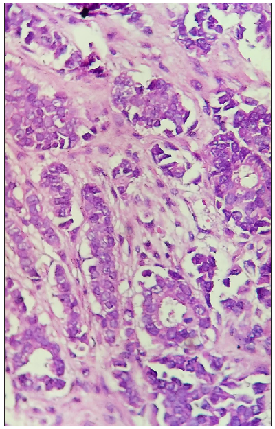 Ductal structures with atypical cells (Haematoxylin & eosin, 400x).