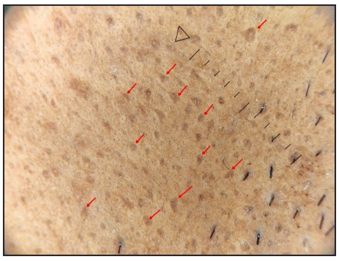 Follicular brown pigmentation (red arrows) (nose) (Heine delta 30, 10x, polarised).