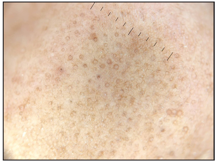 Brown circles around adnexal openings (cheek).